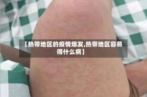 【热带地区的疫情爆发,热带地区容易得什么病】
