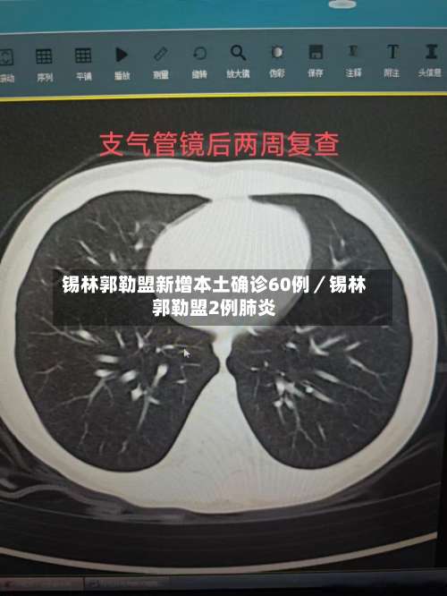 锡林郭勒盟新增本土确诊60例／锡林郭勒盟2例肺炎-第3张图片