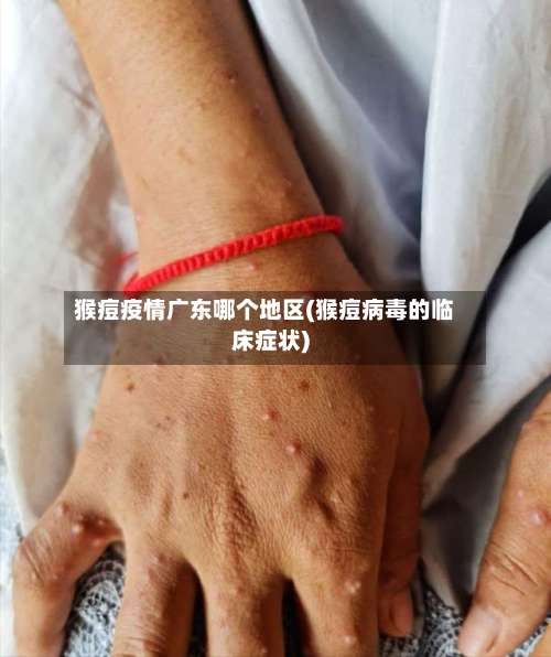 猴痘疫情广东哪个地区(猴痘病毒的临床症状)-第2张图片